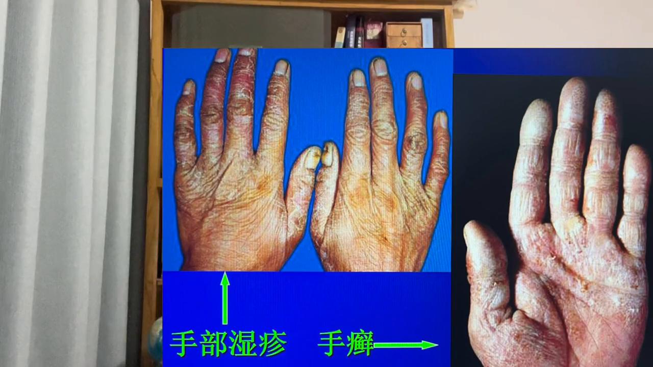 肛周湿疹和肛周癣的区别,手指癣和湿疹的区别