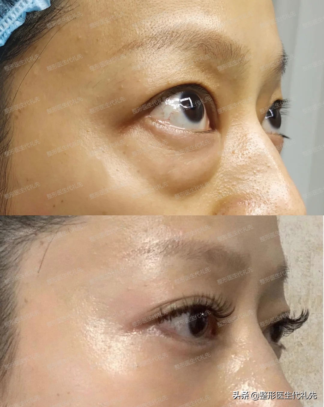 眼袋有皱纹是正常的吗,为什么眼睛下眼袋有点褶皱了