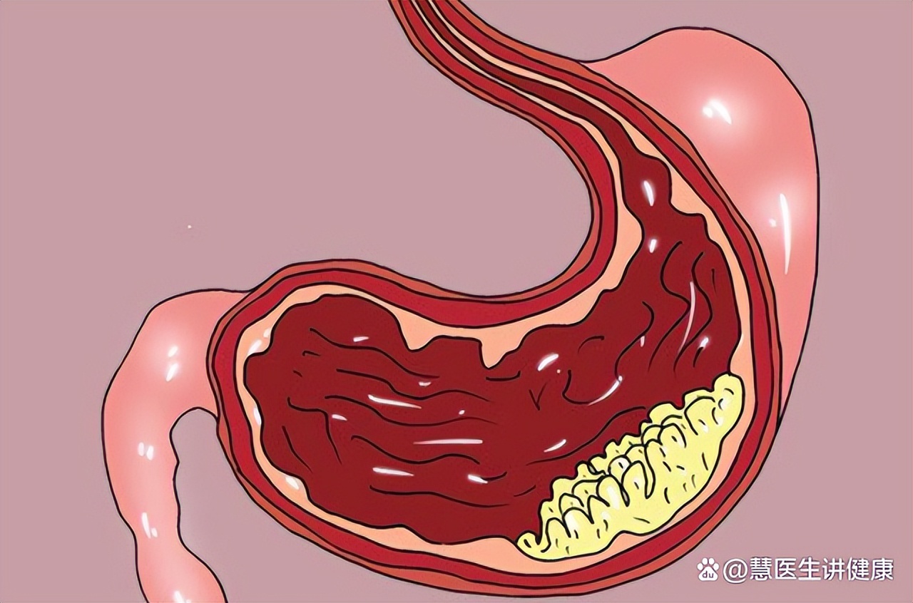从胃炎到胃癌用多长时间,从胃炎到胃癌一般经过哪几个阶段
