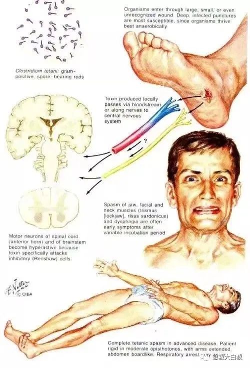 破伤风知识拓展,破伤风打几次针