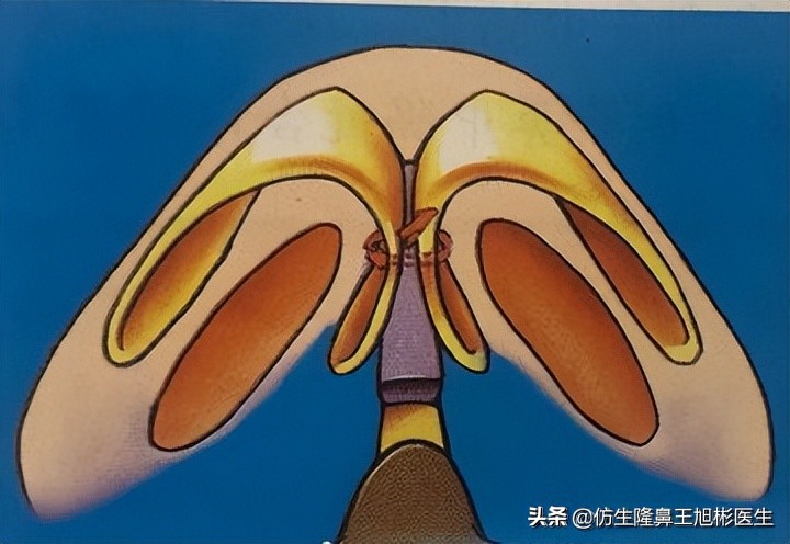 鼻头部位整形,鼻头圆钝高鼻梁整形案例