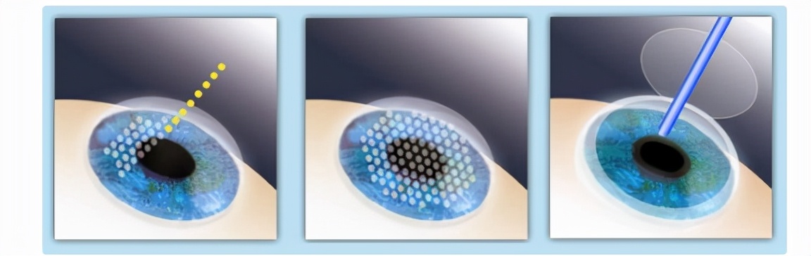 除了激光手术还有什么能矫正近视,近视植入晶体好还是激光矫正好