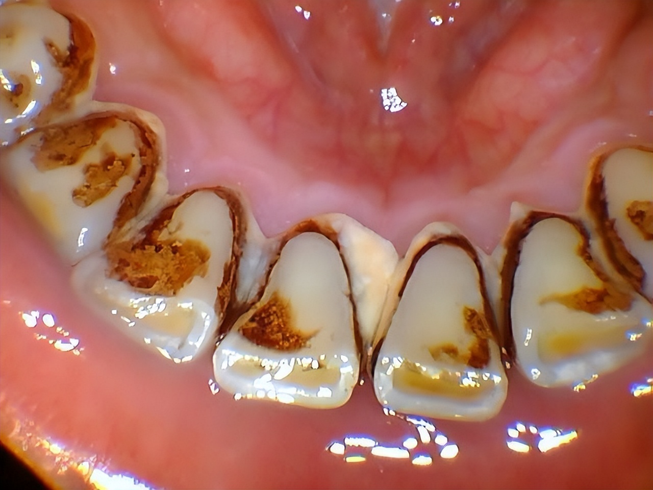牙结石的根除方法,牙结石治疗全过程