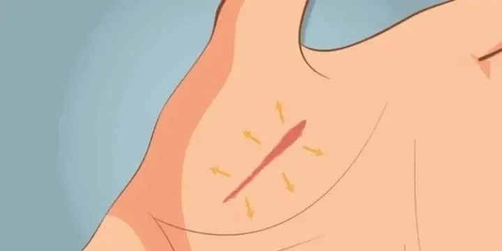 胸前疤痕疙瘩痒是怎么回事,疤痕上特别痒长疙瘩是什么原因