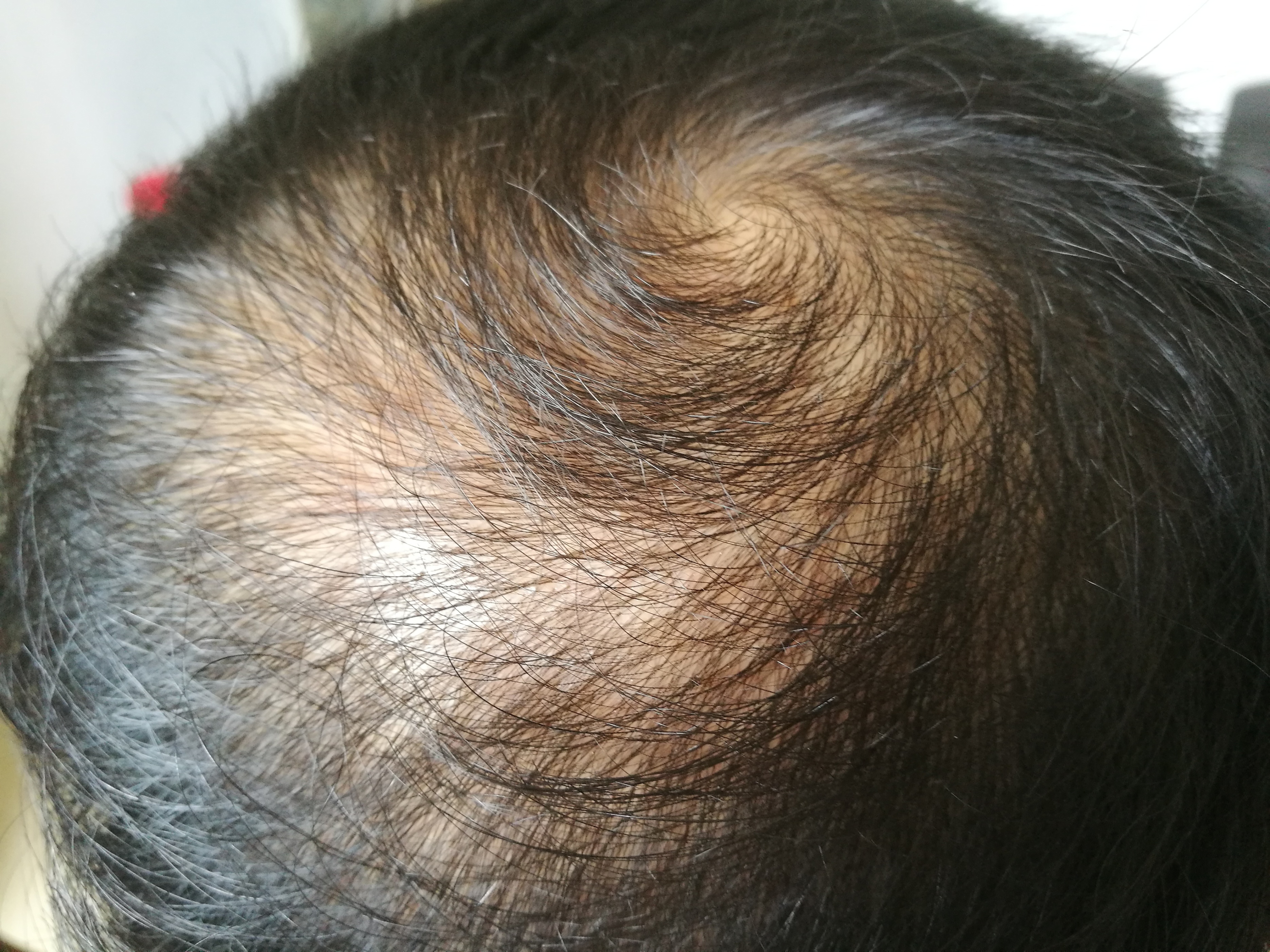 头屑多脱发怎么去除小妙招,头屑如何调理生发最有效