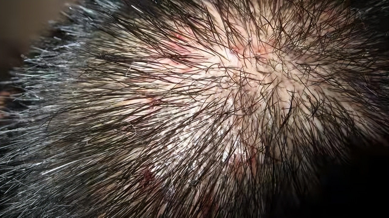 头皮得了毛囊炎怎么治疗效果最佳,头皮出现毛囊炎怎么根治