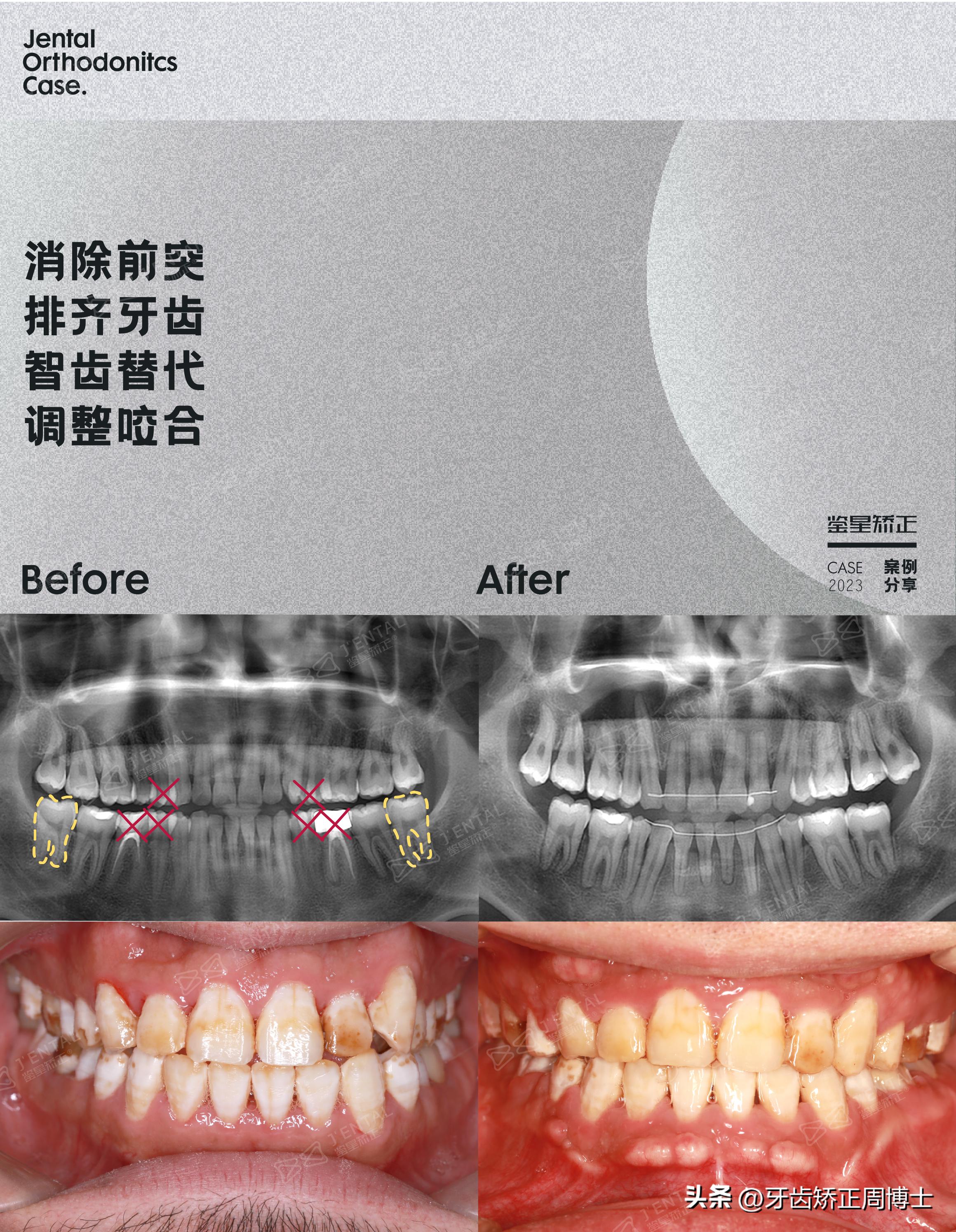智齿正畸替代第二磨牙危害,智齿矫正代替第二磨牙3d图
