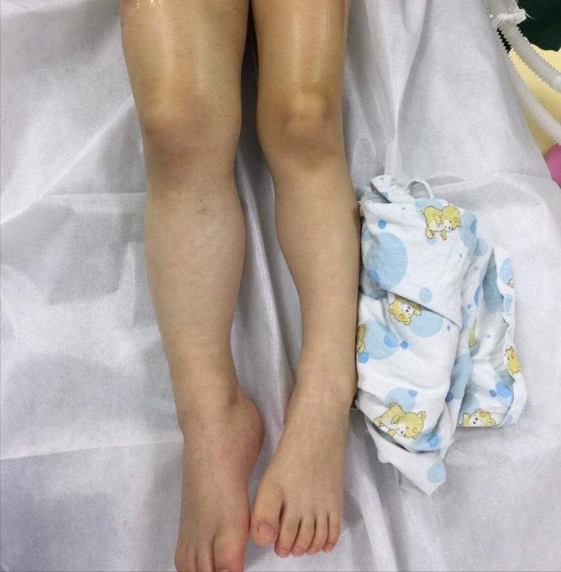 血管畸形伴大静脉瘤扩张,下肢动静脉畸形介入治疗