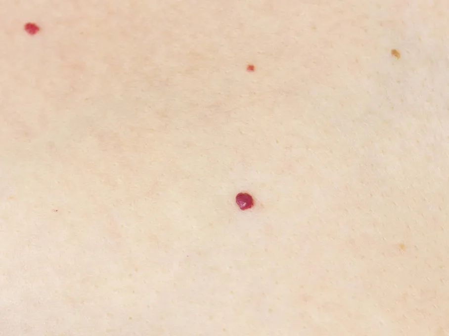 警惕身上出现的小黑痣,警惕皮肤黑痣