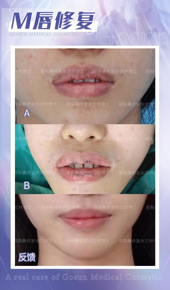 嘴唇厚其实有很多烦恼,嘴唇厚的女生有什么特点