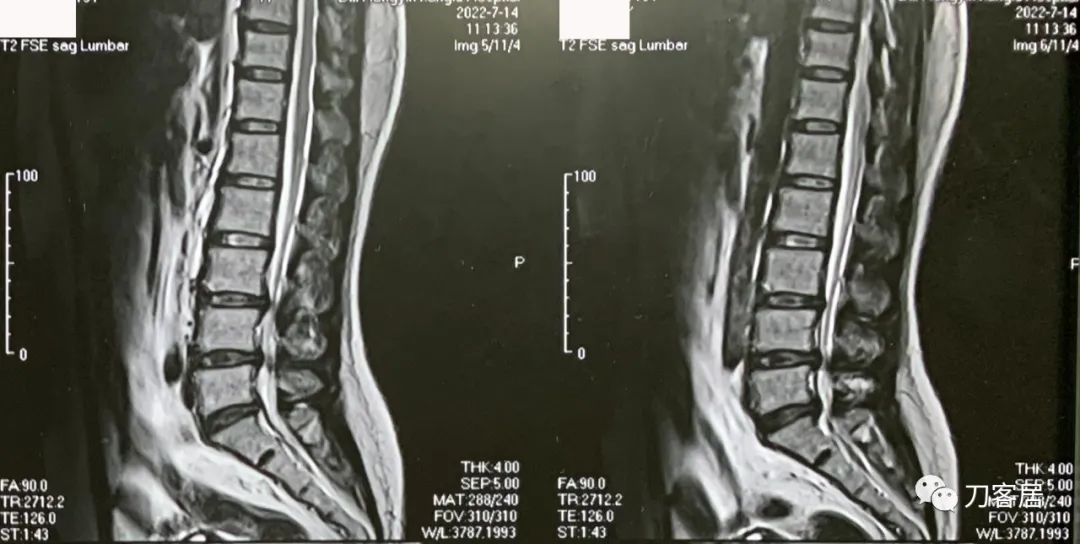 30岁女性左腿麻木是什么病的前兆,50岁的女人右腿经常麻是什么原因