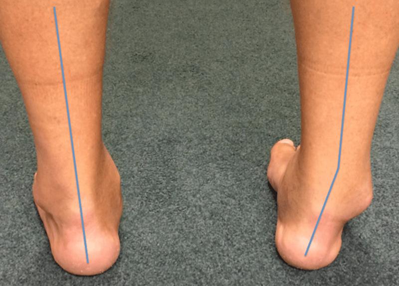 习惯性崴脚踝关节咔咔响怎么治疗,习惯性崴脚加强踝关节力量有用吗