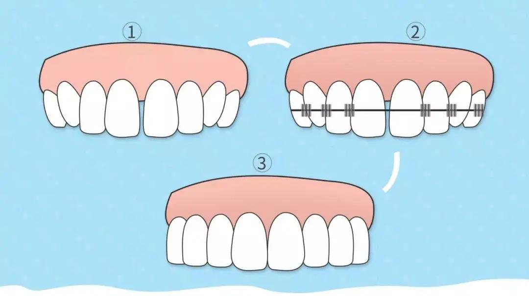 世界微笑日口腔医院,牙齿矫正到什么程度开始训练微笑