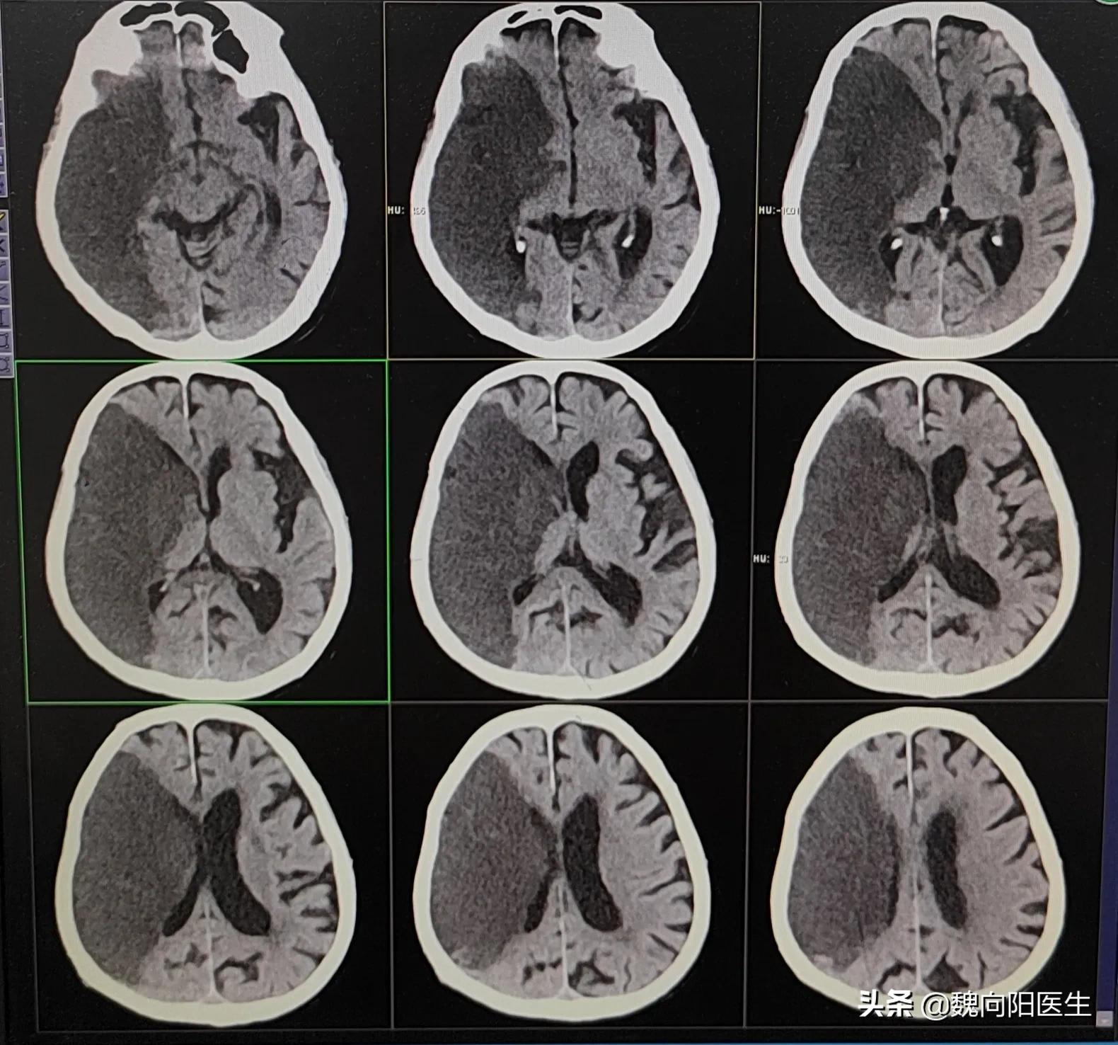 胃溃疡病人不配合插胃管怎么办,下胃管进食胃会不舒服吗