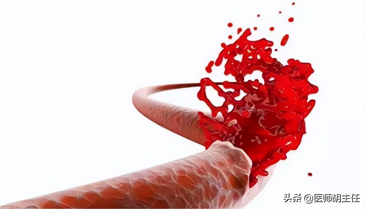 肠道有息肉会出现什么症状,肠道长了息肉有什么症状