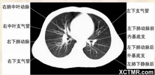胸腹部盆腔ct主要检查什么,女性盆腔ct断层解剖结构图