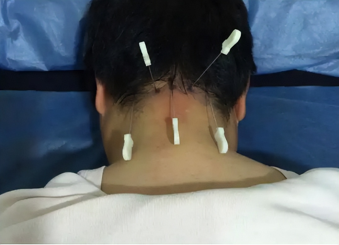 经常头晕中医怎么辨证,头晕中医可以根治吗