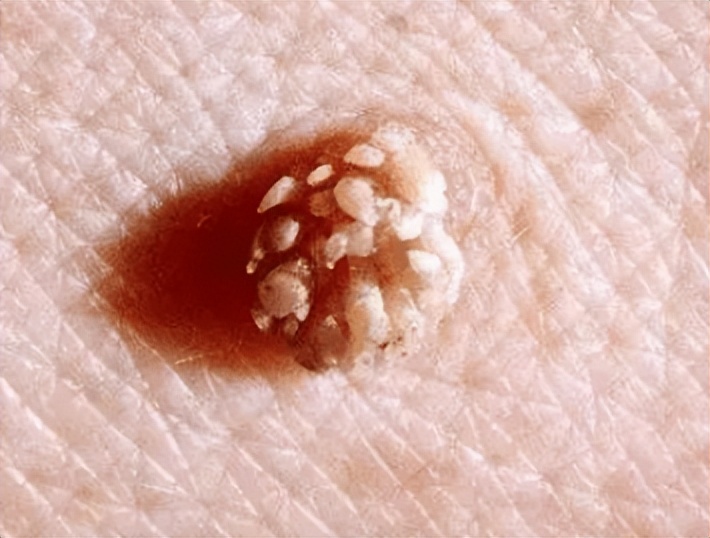 女生得了一颗尖锐性湿疣,女性肛周长湿疣什么原因