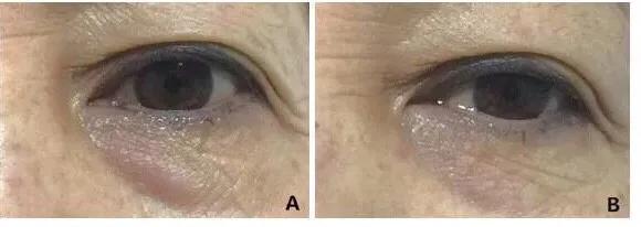 自己怎么修复泪沟,泪沟是消除不了的吗