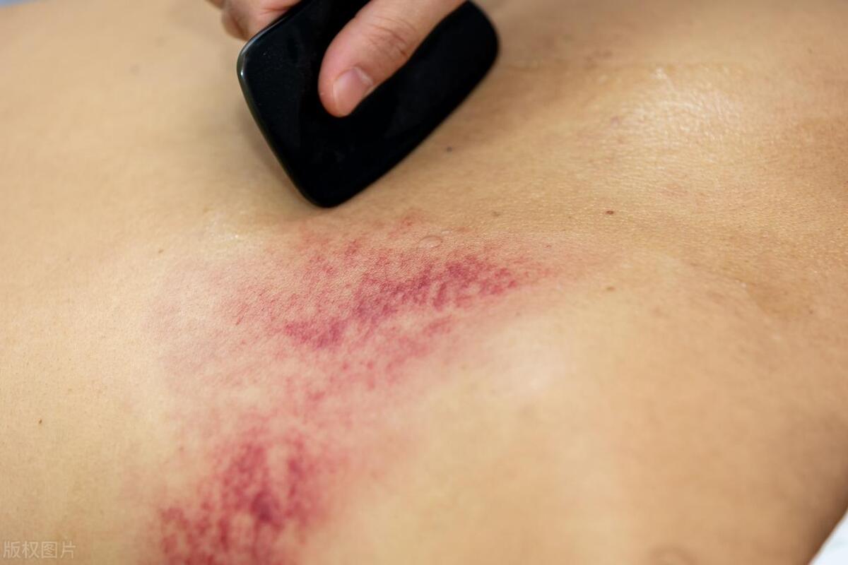 湿疹皮肤溃烂抹什么中药药膏,湿疹用的中药外用药