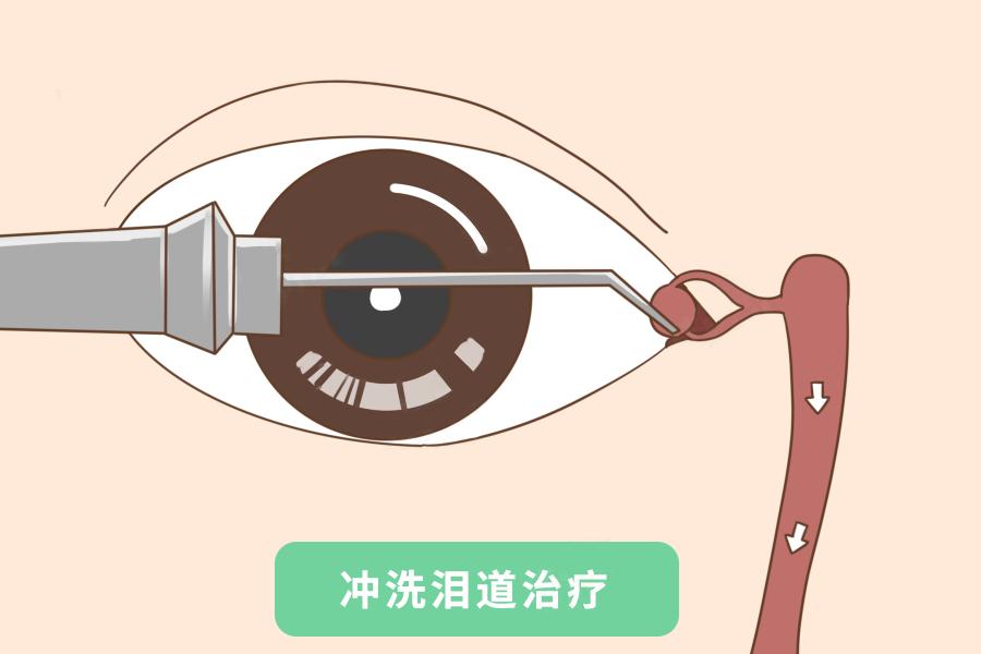 宝宝眼部分泌物多是喝奶粉“上火”？警惕泪囊炎