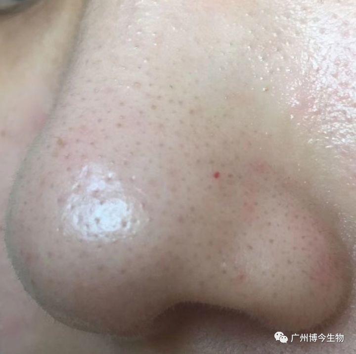 大数据请把这篇文章推给有“黑头”烦恼的人