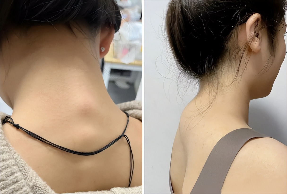 富贵包真的很丑吗,有富贵包会影响寿命吗