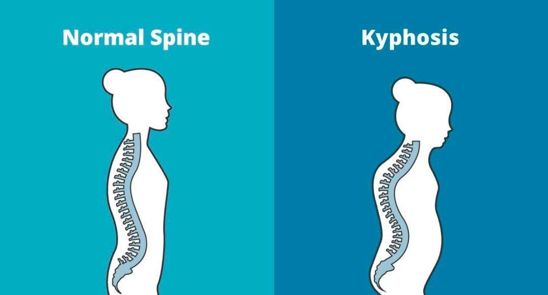 胸腰椎侧凸畸形,腰椎后凸畸形