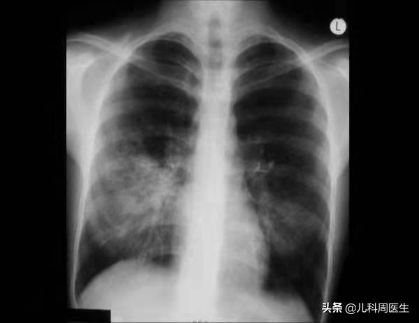 小儿支原体肺炎最佳治疗方法,小儿支原体肺炎治疗过程