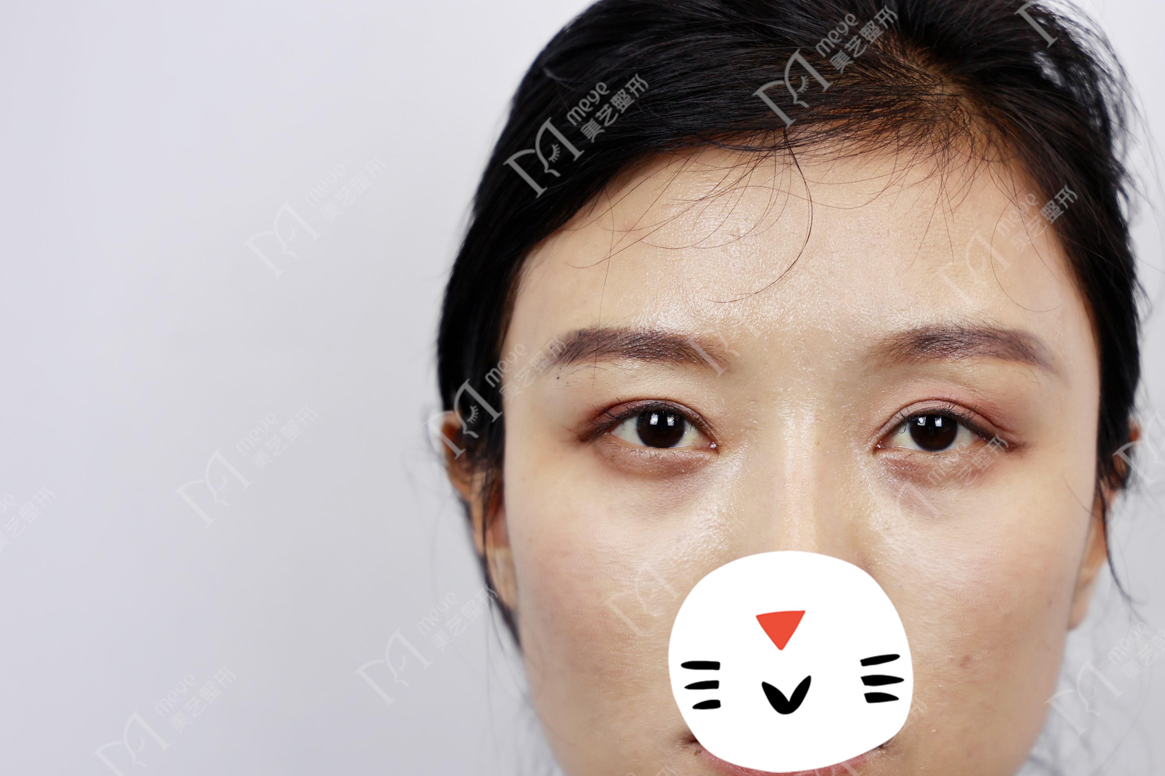 我做了双眼皮下眼睑会肿怎么回事,做了双眼皮十天肉条感严重怎么办