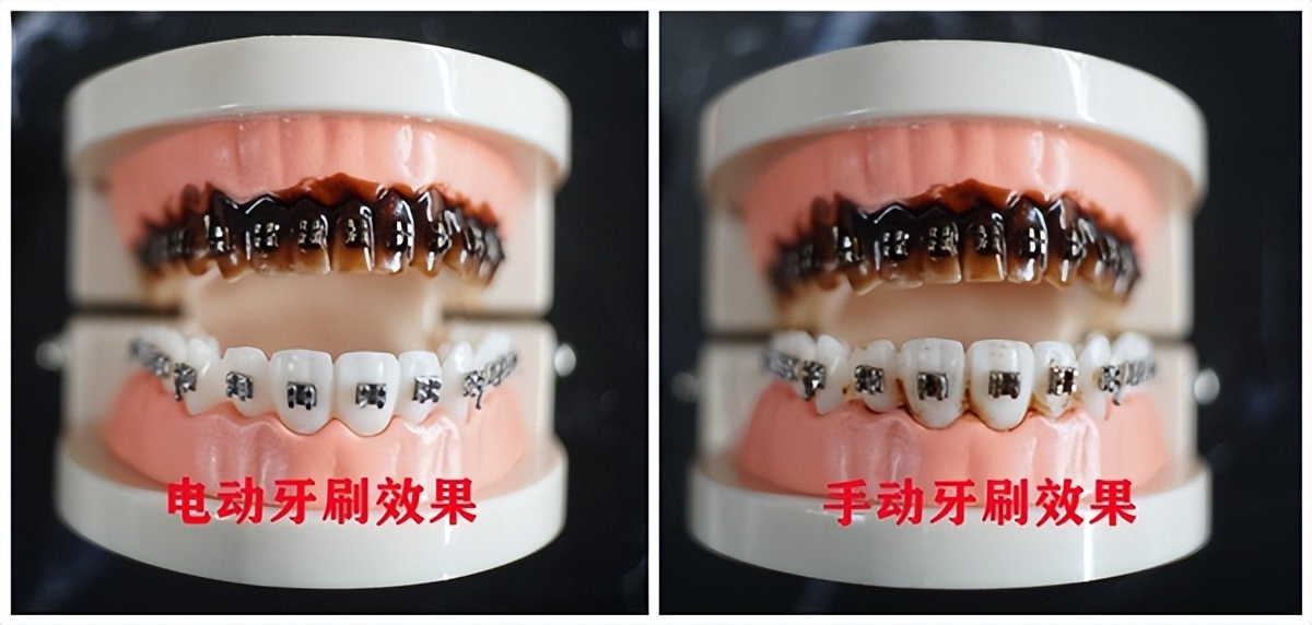 电动牙刷对牙齿有什么好处和坏处,儿童电动牙刷的利弊
