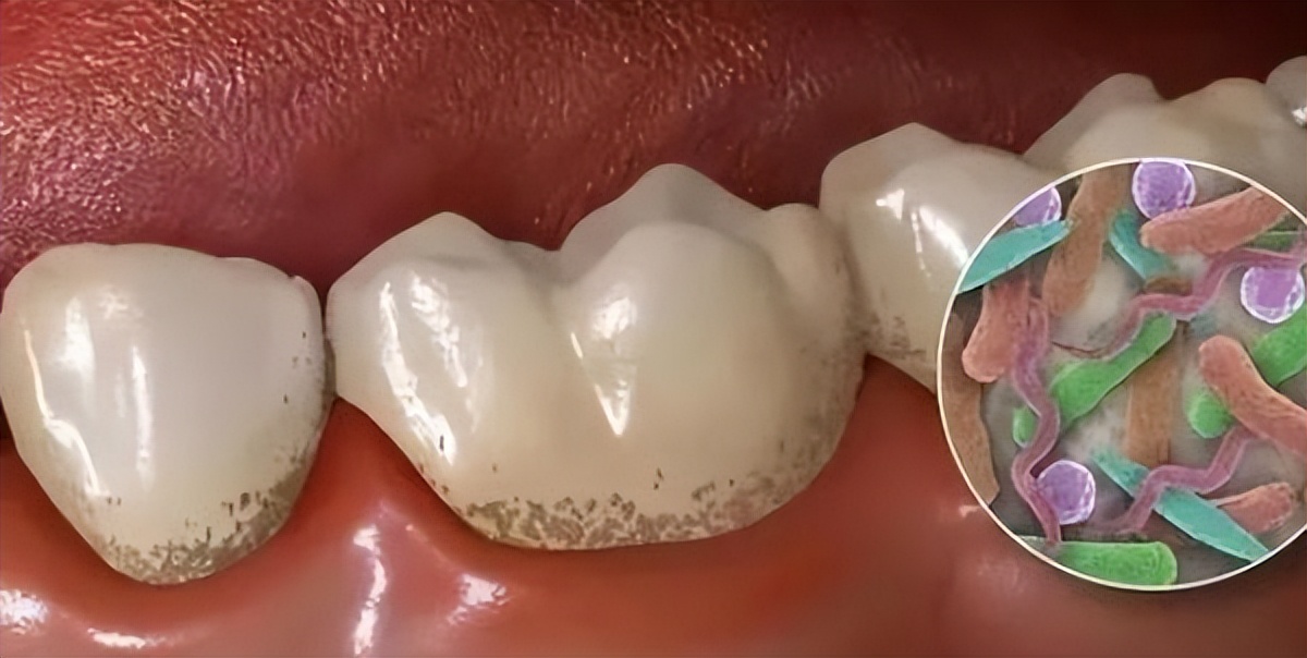 洗牙危害大还是不洗牙危害大,为什么有人说洗牙对牙齿有伤害啊