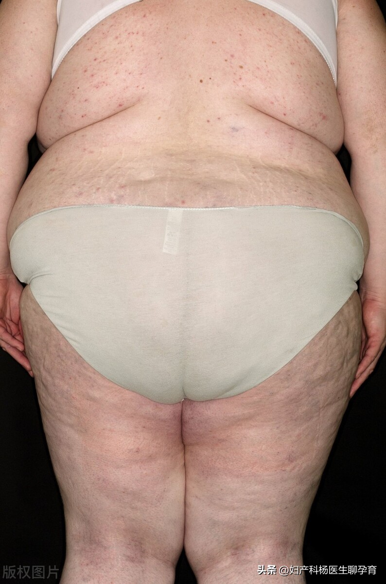 多囊卵巢会影响子宫内膜病变吗,多囊子宫内膜增生严重吗