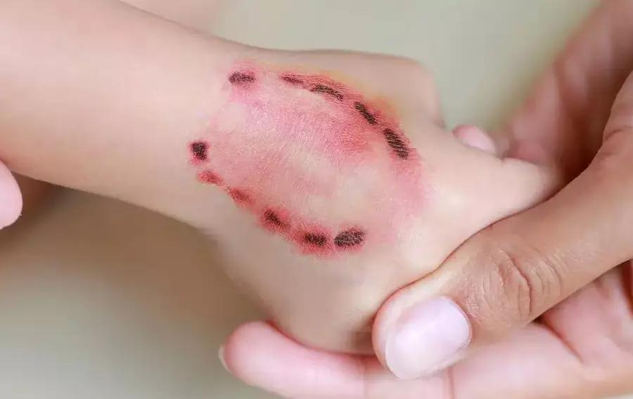 宝宝爱咬人怎么办,幼儿园咬人案例怎么跟家长沟通