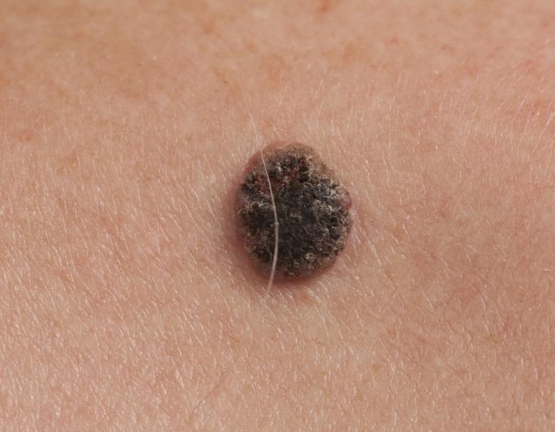 这8个部位长痣或是癌症前兆,痣长在身体这8个部位要小心癌症