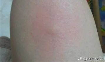 被蚊虫叮咬起大包涂仙人掌有用吗,儿童大腿内侧蚊虫叮咬大包红肿硬