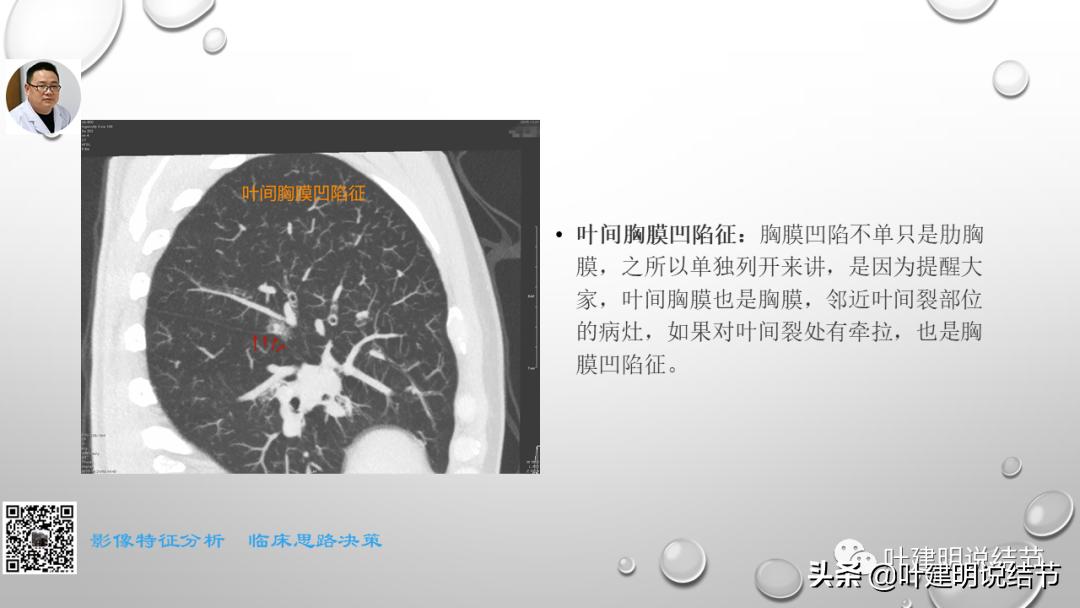 在《一脉阳光》呼吸影像诊断专题培训班上的讲课PPT（第一部分）