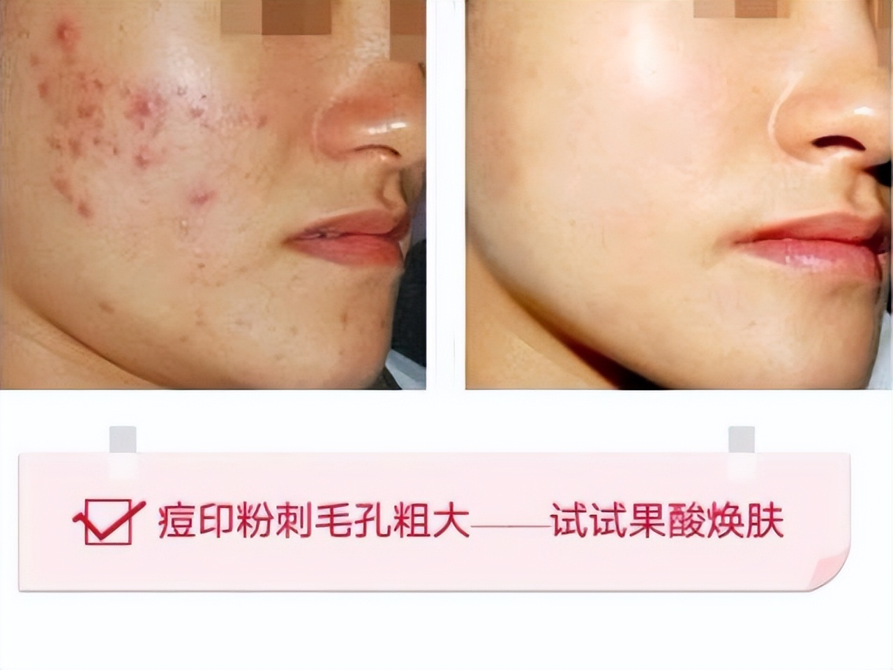 果酸换肤能彻底去除皱纹吗,果酸换肤多久剥落老化角质