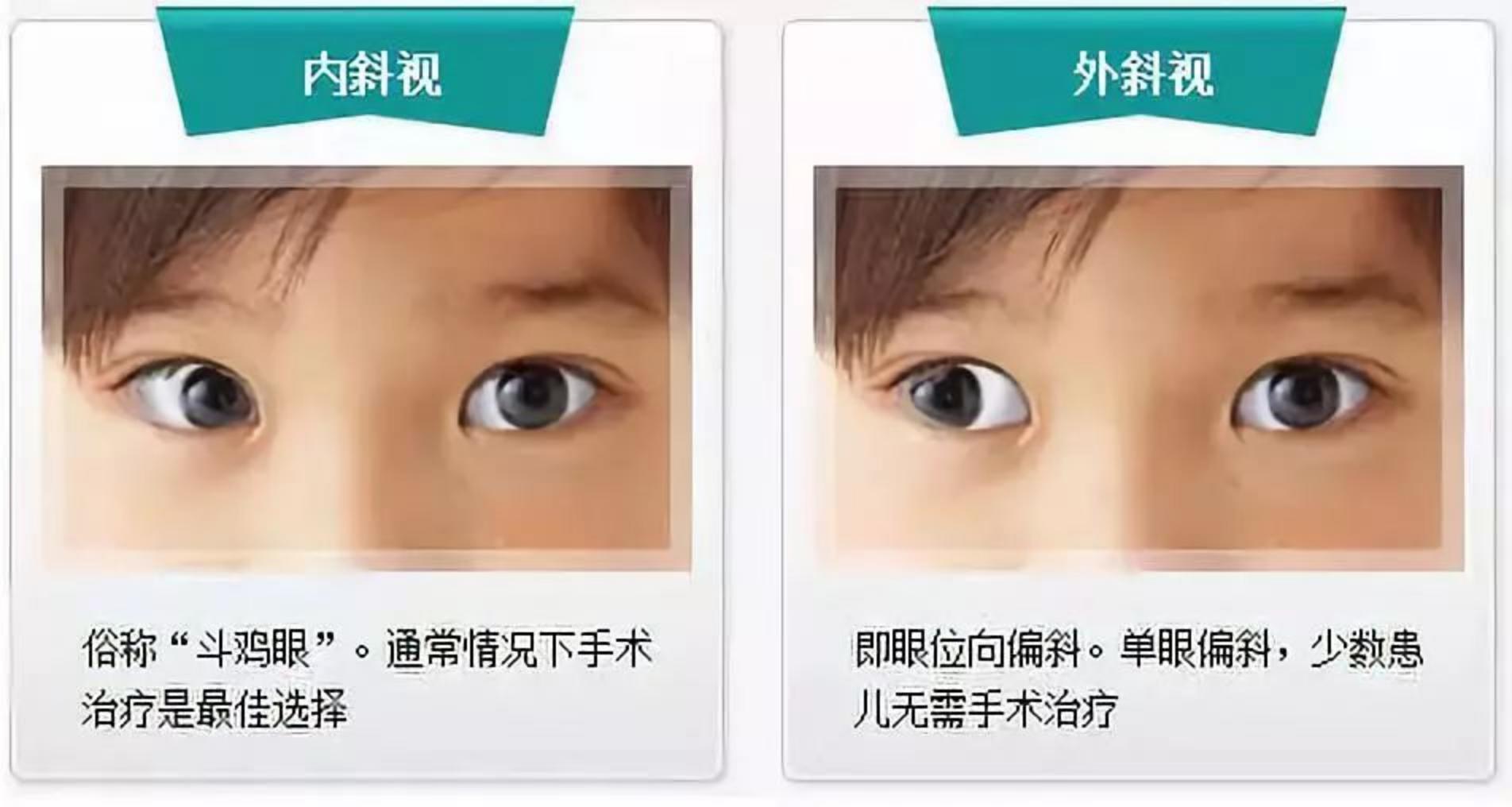 宝宝斜视导致歪头怎么治疗,小孩老是歪头斜眼怎么办不斜视