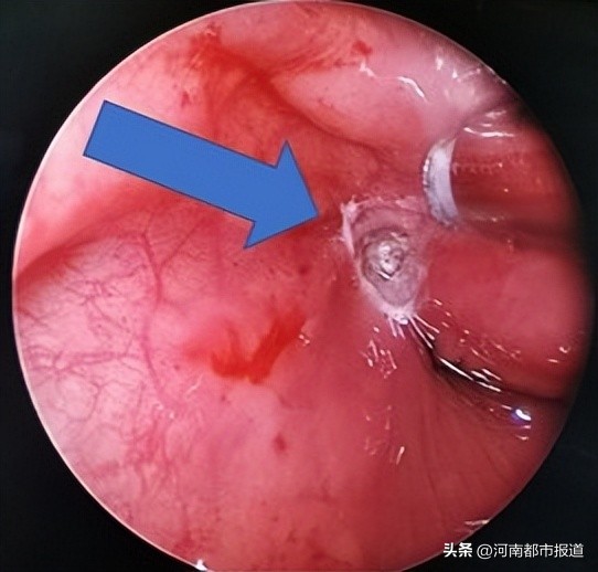 喉咙长了个小洞,喉咙里长了一个小泡要不要扎破