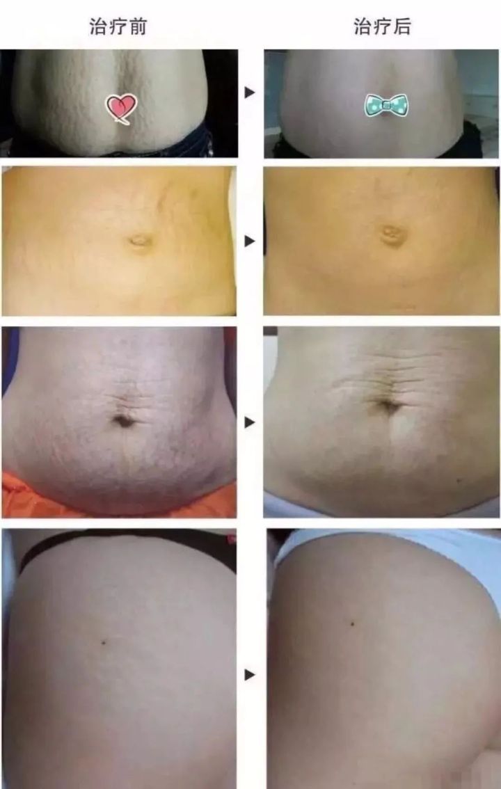 乳腺有妊娠纹可以做点阵激光吗,宁波点阵激光祛妊娠纹一次多少钱