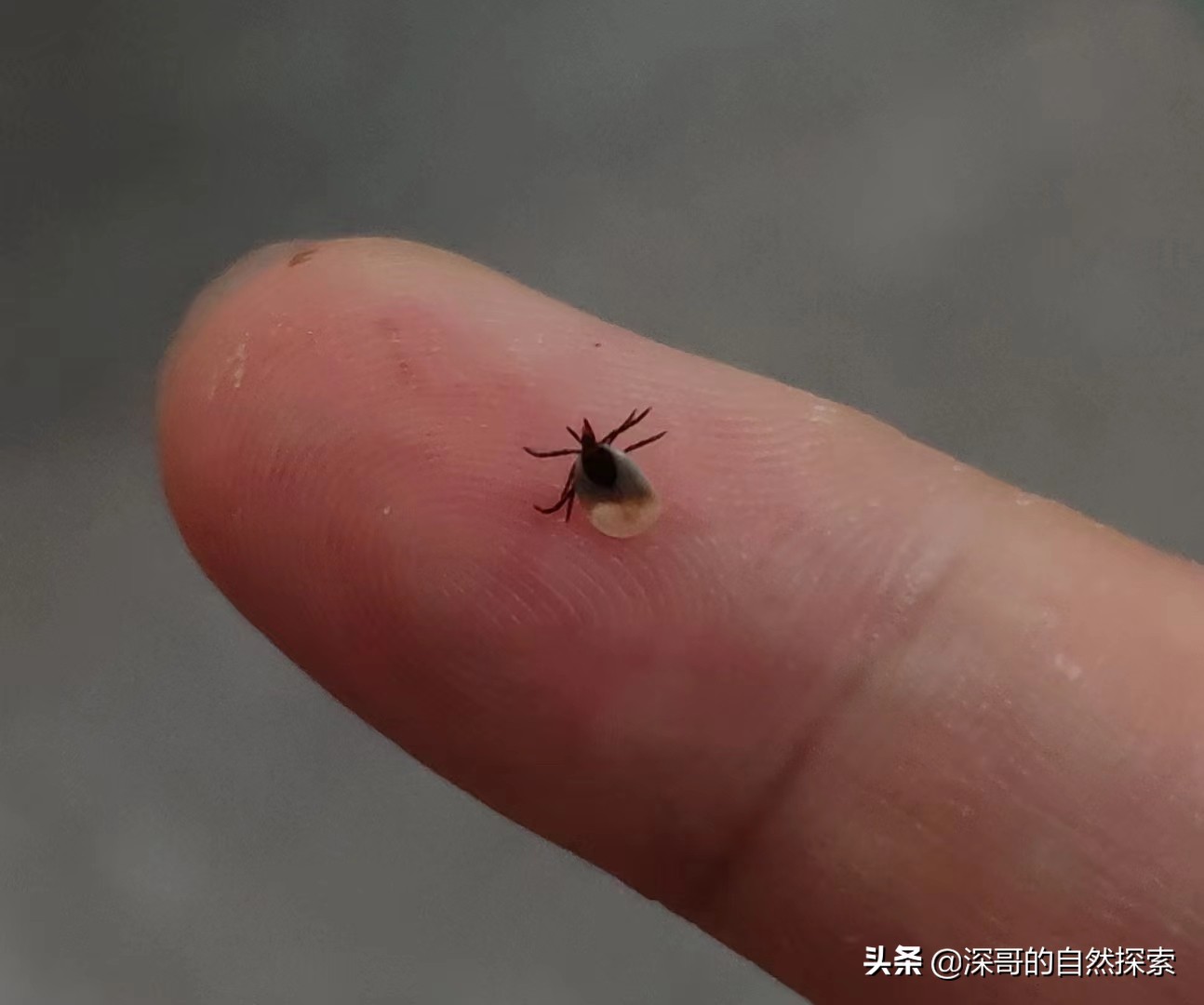 在深圳被小黑虫咬了,户外游玩被蜱虫咬到的视频