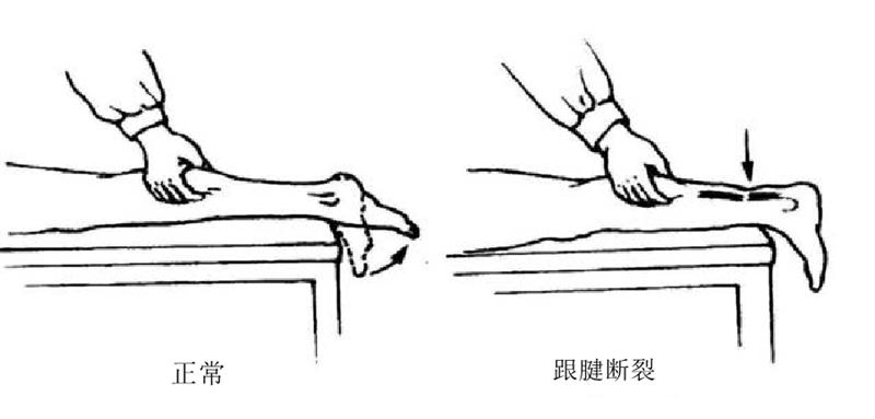 运动员跟腱断裂能恢复到100%吗,足球运动员跟腱断裂影响大吗