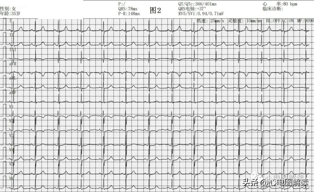 II、III、aVF导联的正常q波、异常Q波
