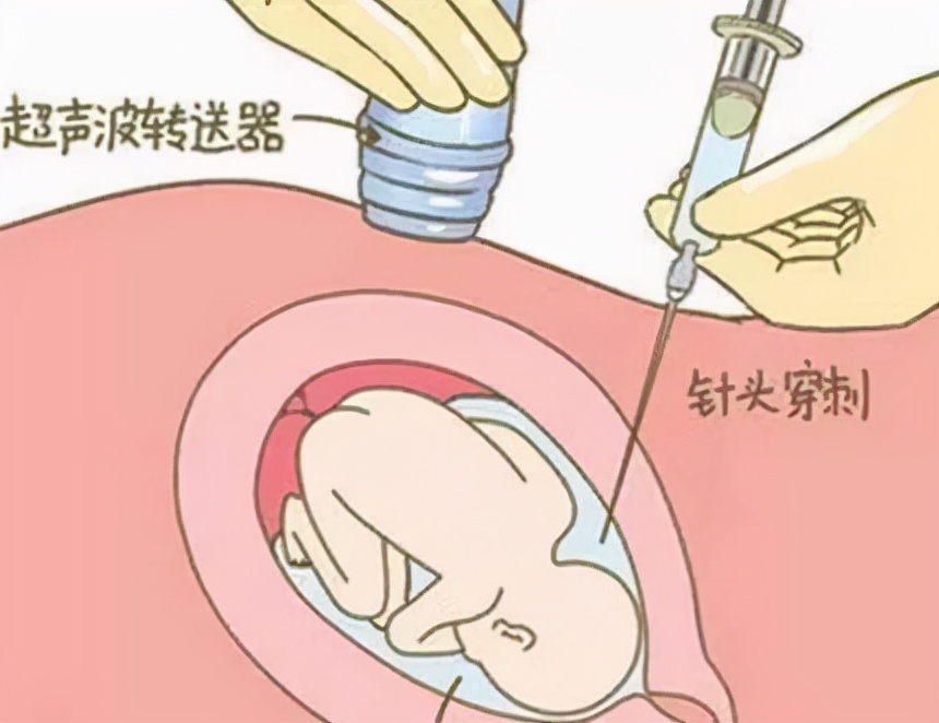 如何正确认识唐筛,唐筛第一项