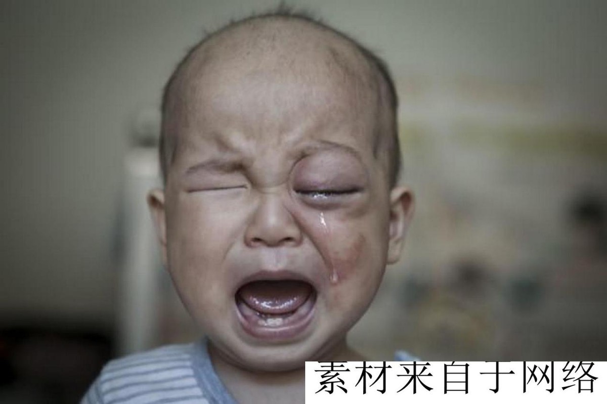 广西一男童出生玻璃眼,男婴出生37天双眼像玻璃珠