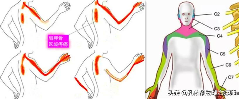 神经根颈椎病的症状和治疗方法,椎动脉颈椎病的症状和治疗方法