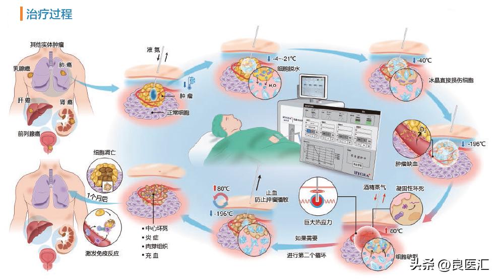 栓塞介入能消灭肿瘤吗,手术不用刀