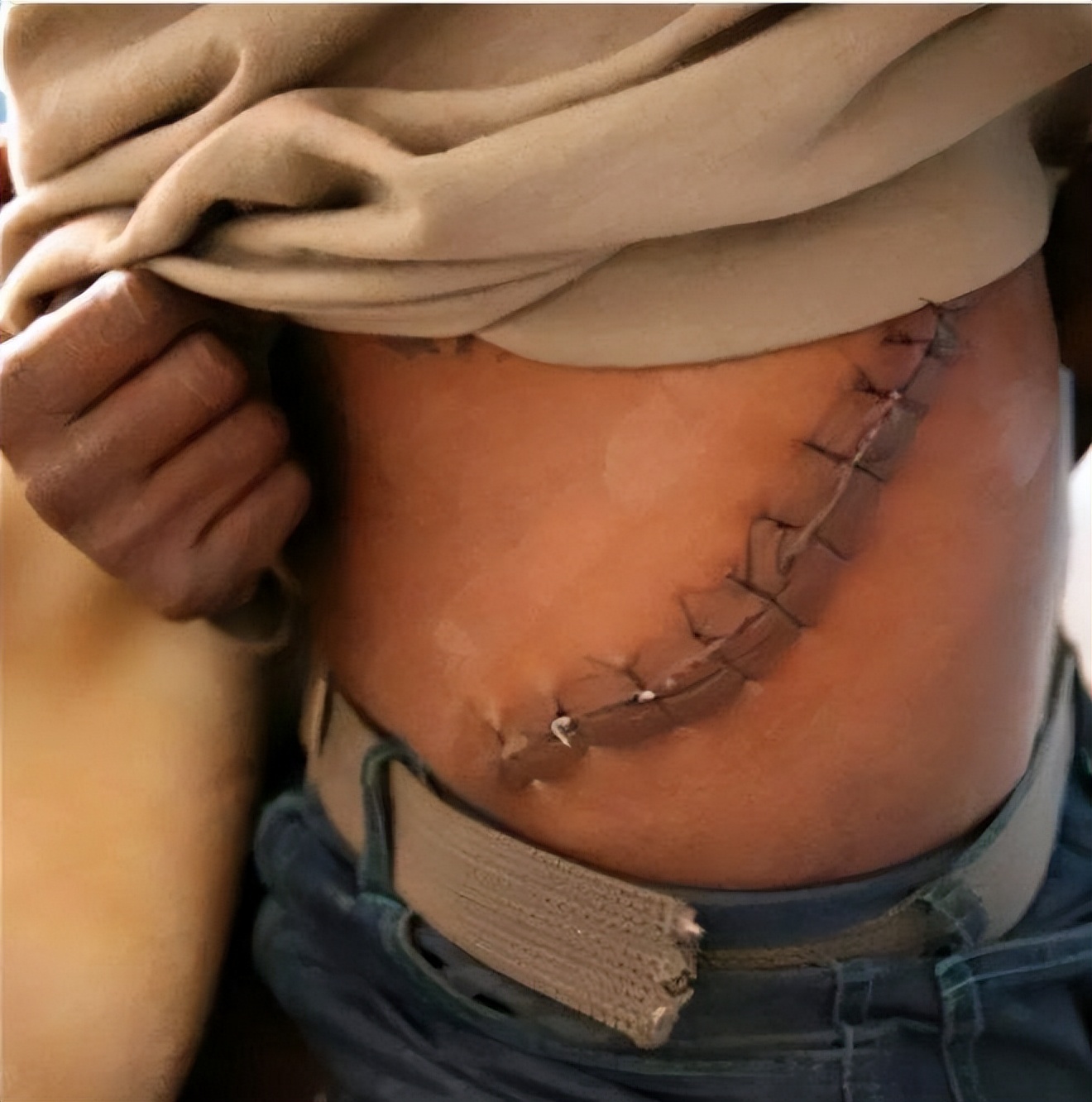 尼泊尔的单肾村,尼泊尔单肾村