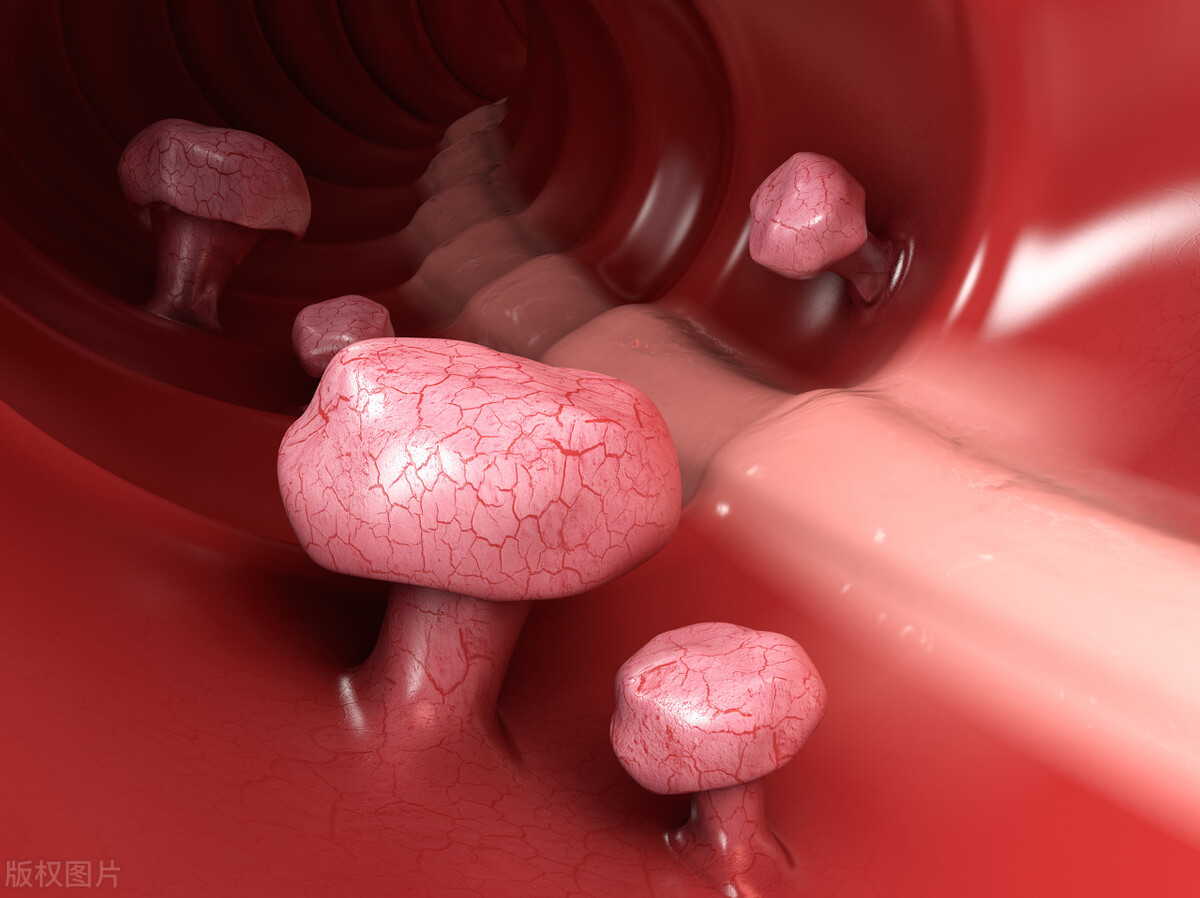 不容忽视的息肉很容易变成癌,肠息肉不可小觑